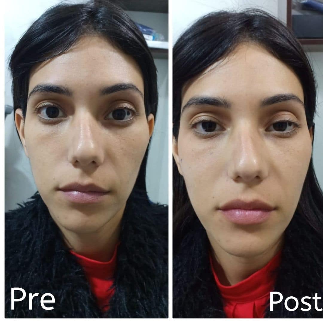 الفيلر لملء الخدود